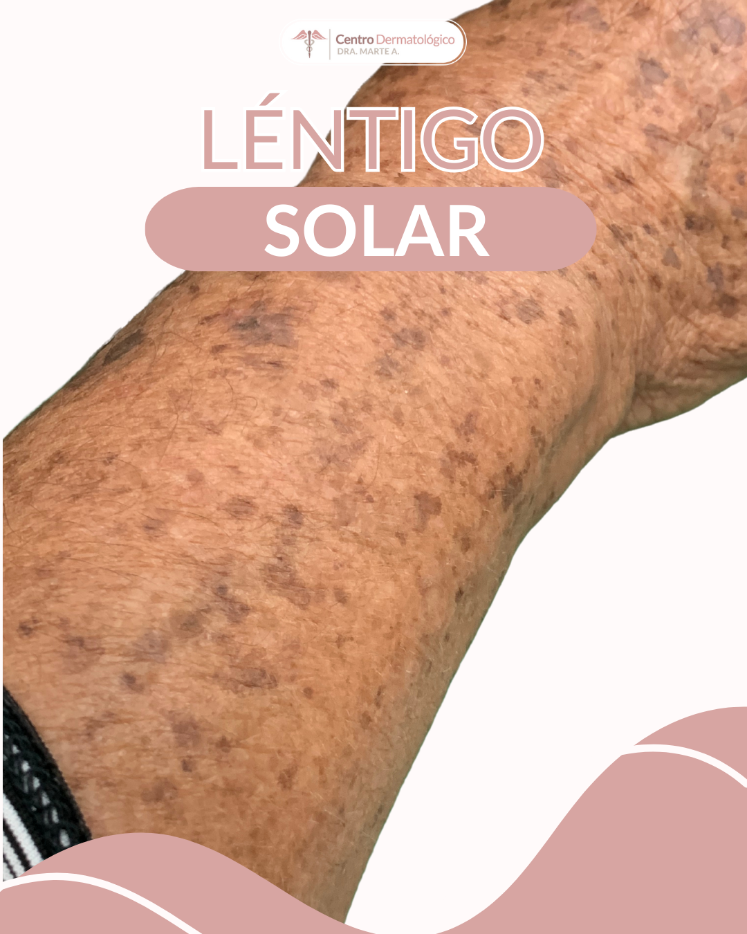 Léntigo solar: cómo prevenir las manchas del sol antes de que aparezcan