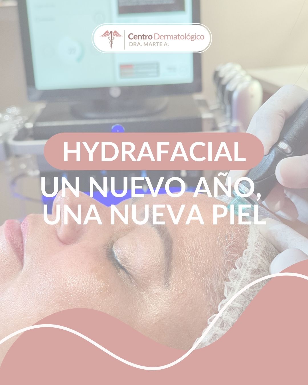 HYDRAFACIAL: El tratamiento ideal para renovar tu piel en esta temporada